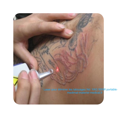 Laser pour éliminer les tatouages Nd: YAG 500W portable